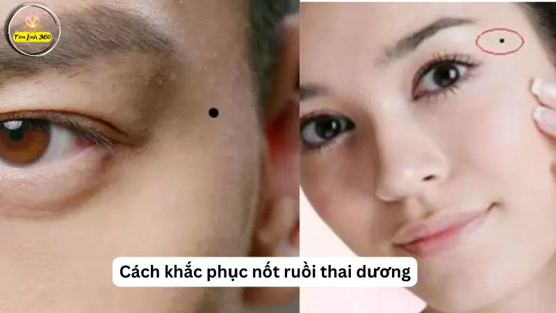 cach khac phuc not ruoi thai duong xau